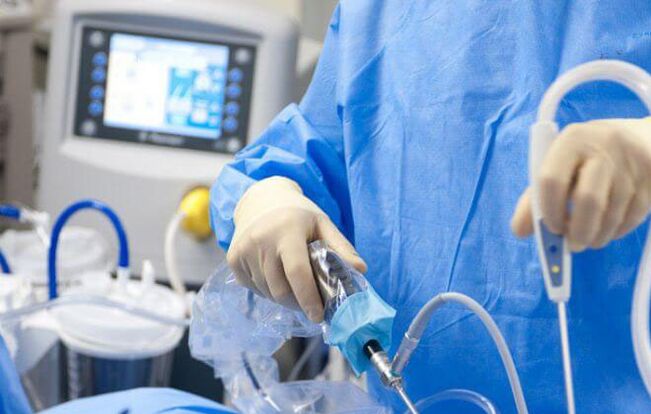 Laparoscopy