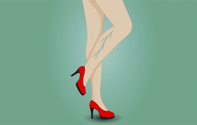 Varicocele veins on woman's legs