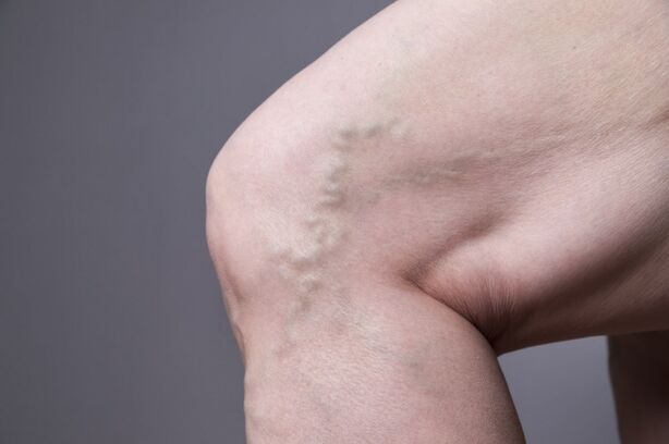 Varicocele veins in women
