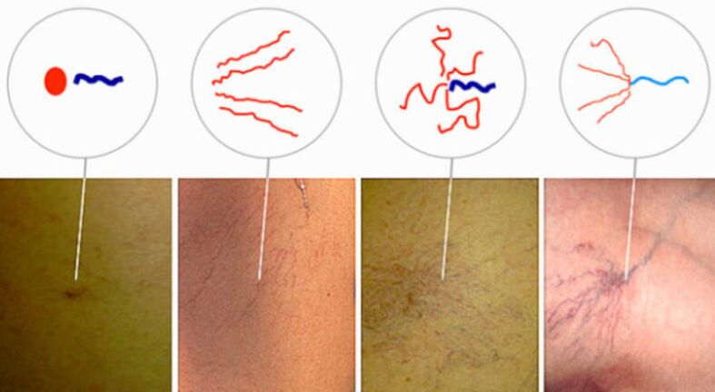Spider veins in early stages of varicose veins