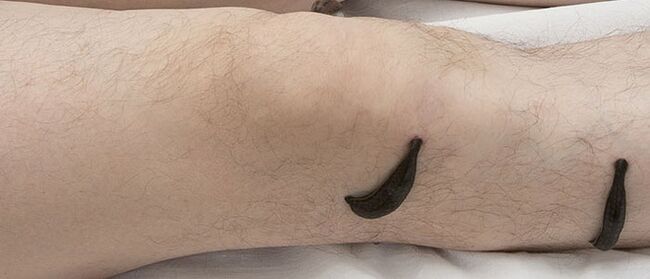Leech therapy