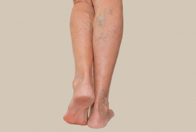 Varicose veins in legs