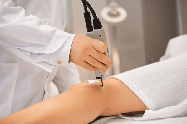 Lower extremity vein laser coagulation