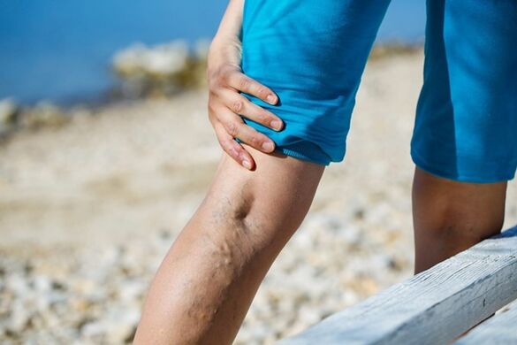 Varicose veins and persistent leg pain