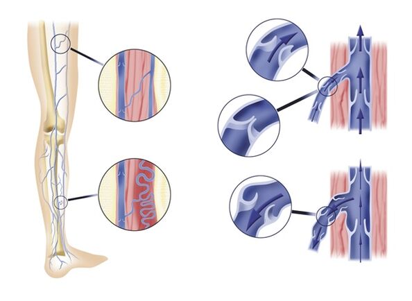 Varicose veins due to venous valve insufficiency