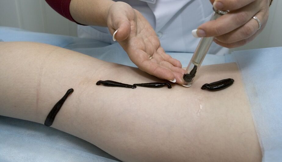 Leeches for varicose veins