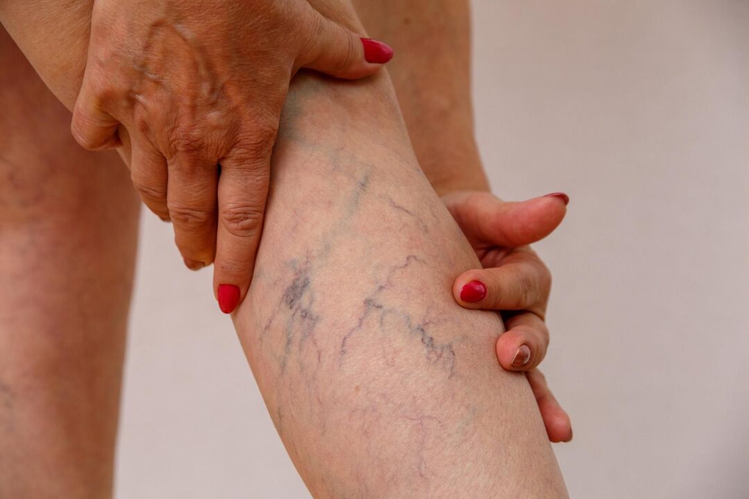 Varicose veins in the legs