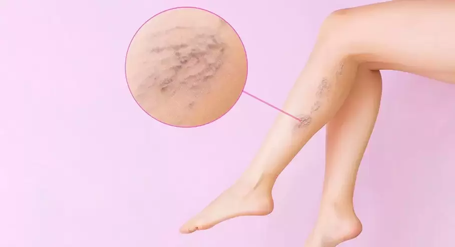 varicose veins zigzag prominent veins on the legs