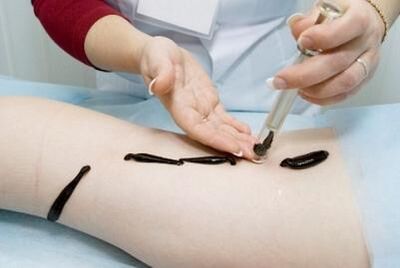 Leeches for varicose veins - an effective remedy in traditional medicine