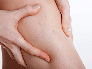 varicose veins leg pain