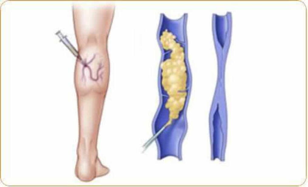 Examples and clear results of sclerotherapy for varicose veins