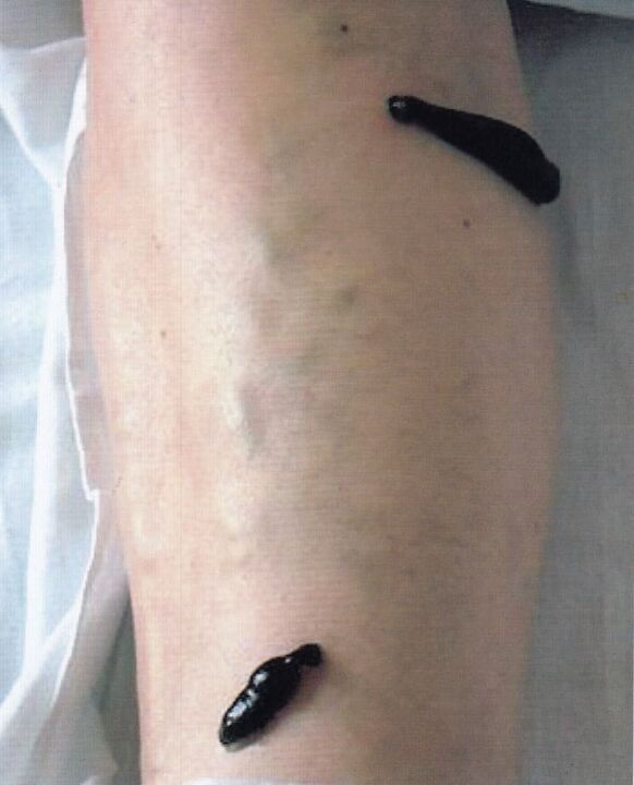 Leech Therapy – Using leeches to treat varicose veins in the legs