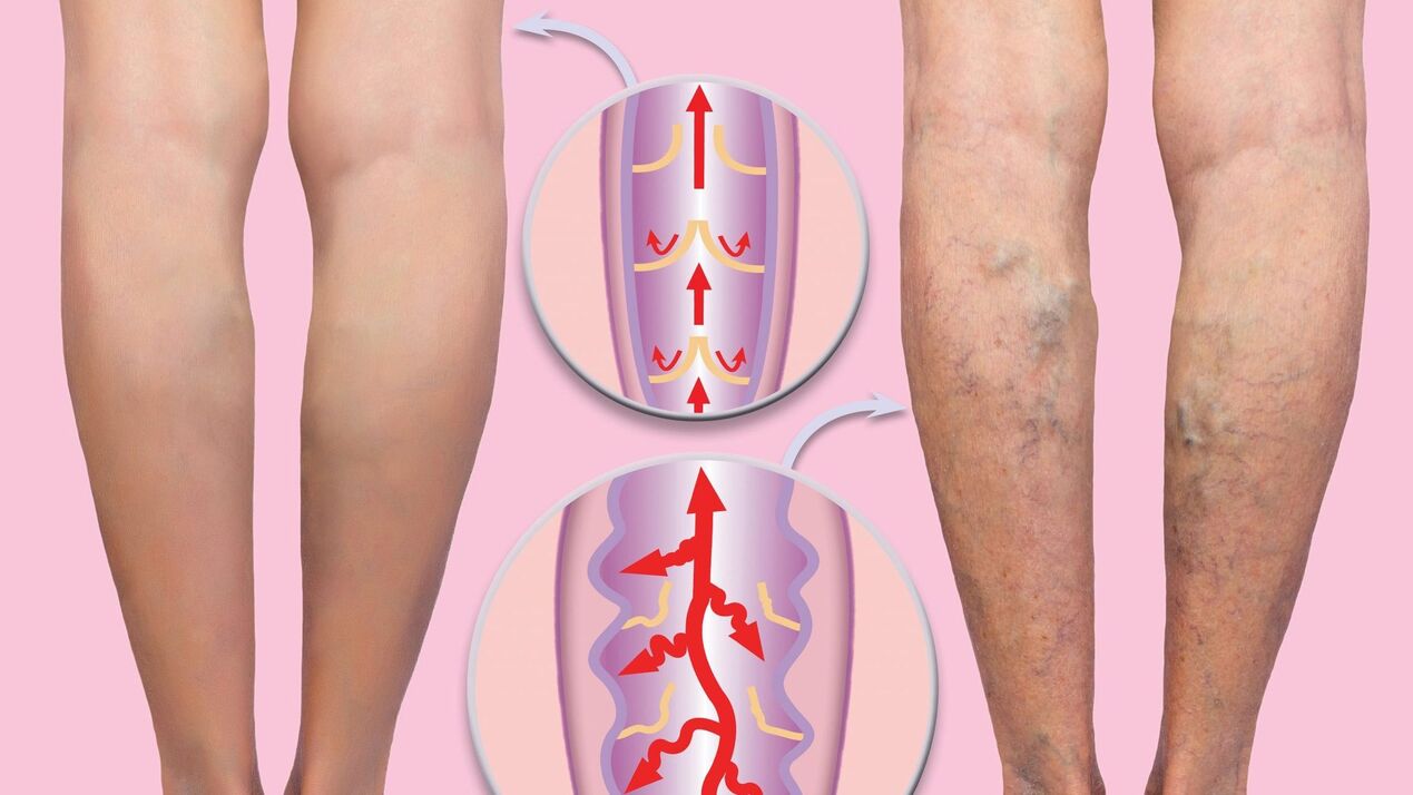 Varicose veins in female legs